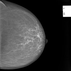 Mammografie